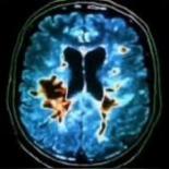 Рассеянный склероз | Неврология | Медицина | Multiple sclerosis | Neurology | Medicine